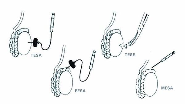 Фото: ВРТ при секреторной форме бесплодия
